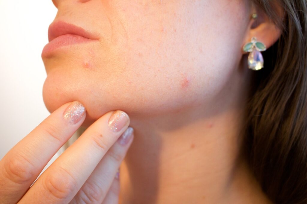 acne, pores, skin-1606765.jpg